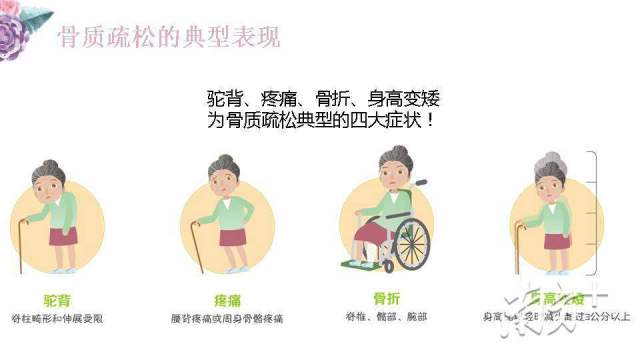 这个病正成为女性的 影子杀手 这样补钙效果最好 南方plus 南方