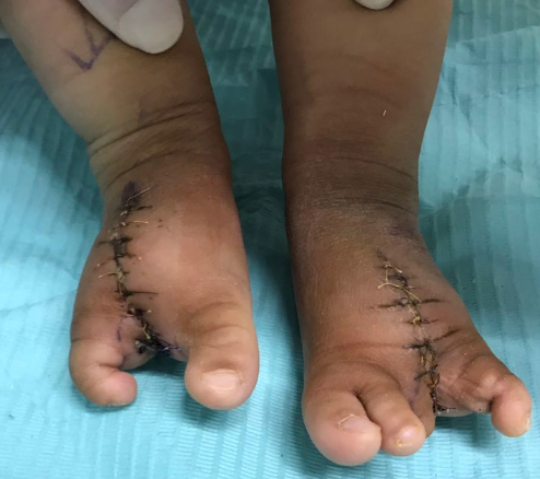 手术后靓靓的两脚