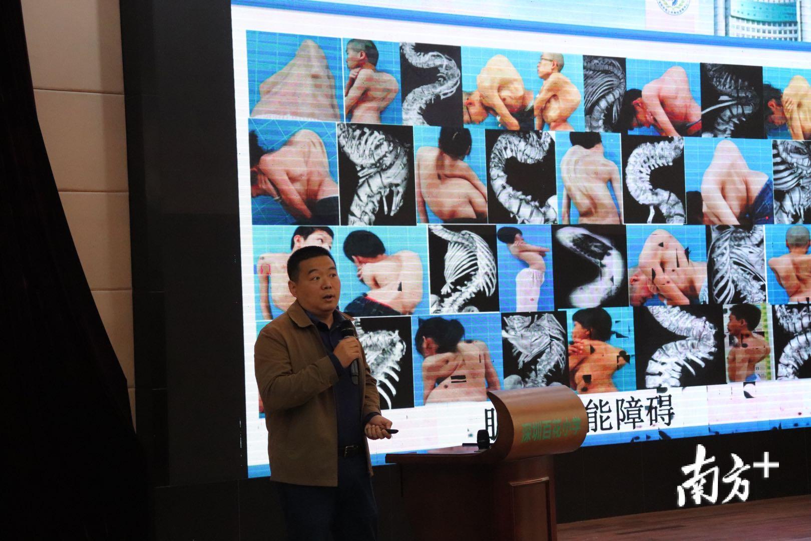 颜滨介绍深圳青少年脊柱侧弯发病情况