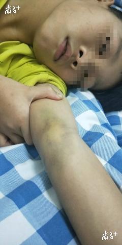 孩子手关节出现明显淤青。受访者供图 孩子手关节出现明显淤青。受访者供图
