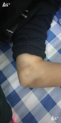 被打孩子身上出现淤青。受访者供图 被打孩子身上出现淤青。受访者供图