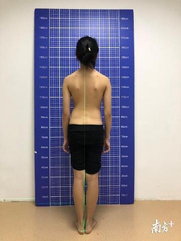 深圳100个中小学生就有5个脊柱侧弯