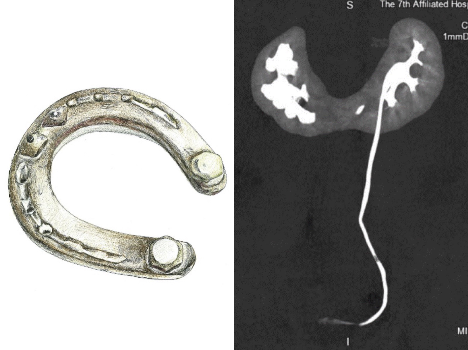 马先生的肾脏术前CT（右）和马蹄铁（左）的对比