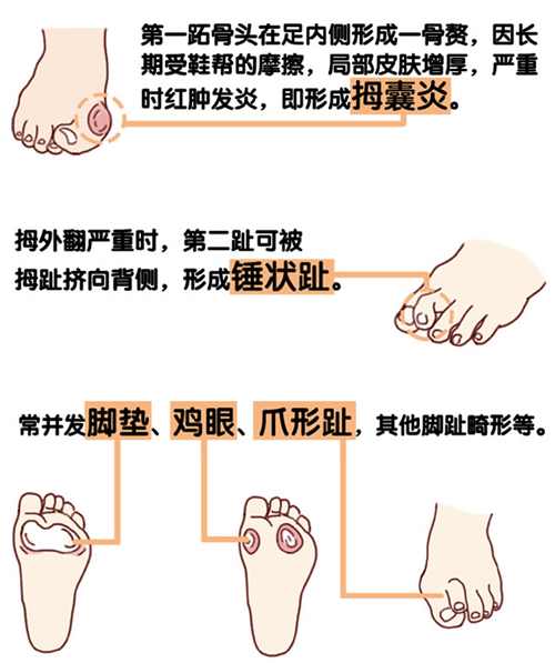 高跟鞋vs踇外翻 要美还是要健康 南方plus 南方
