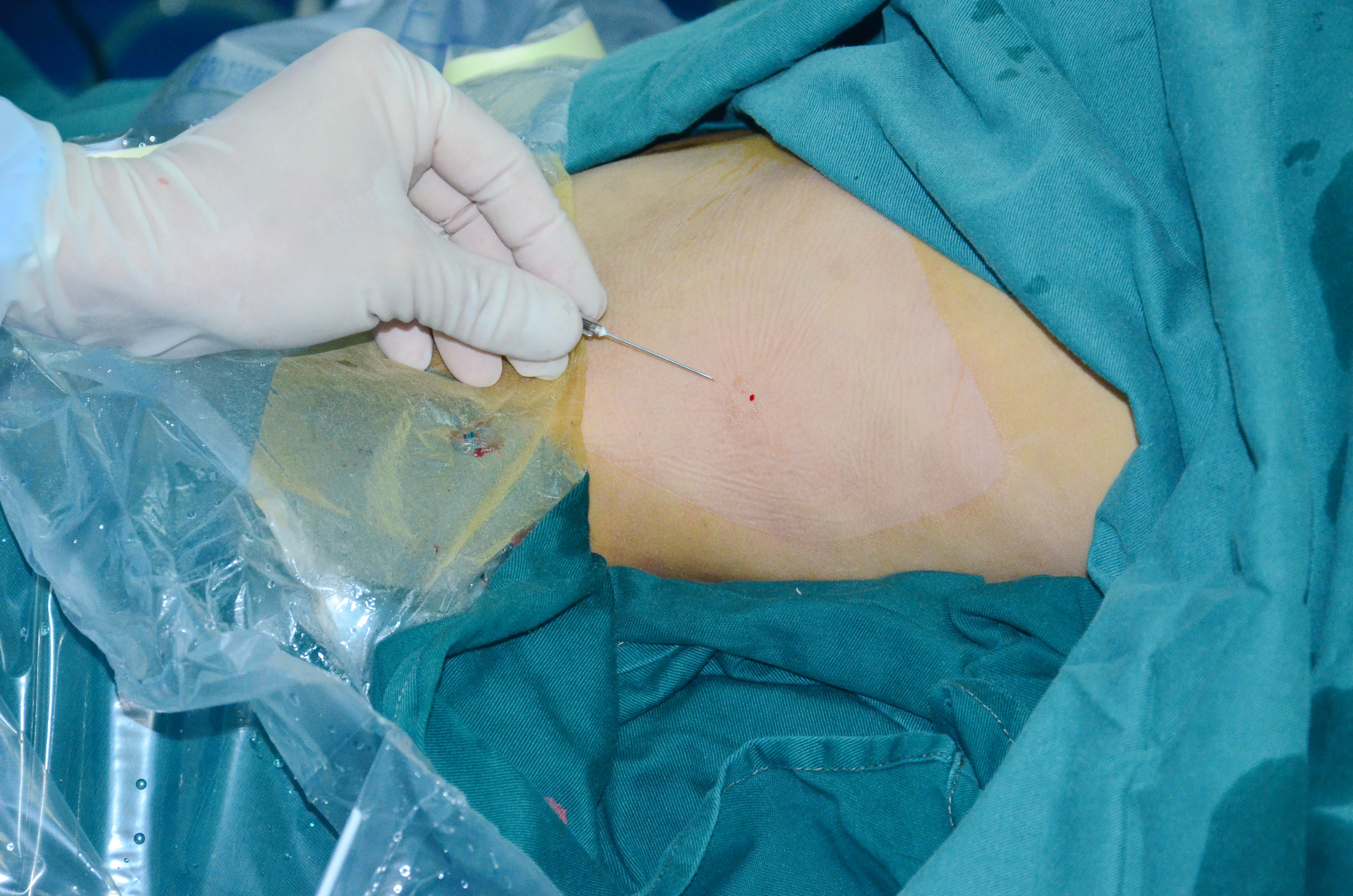 许可慰主刀的微创手术,创口只有针眼大小