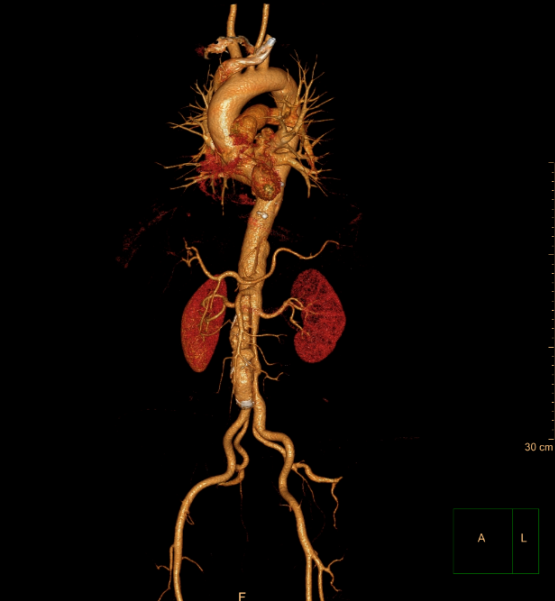 主动脉CTA图片