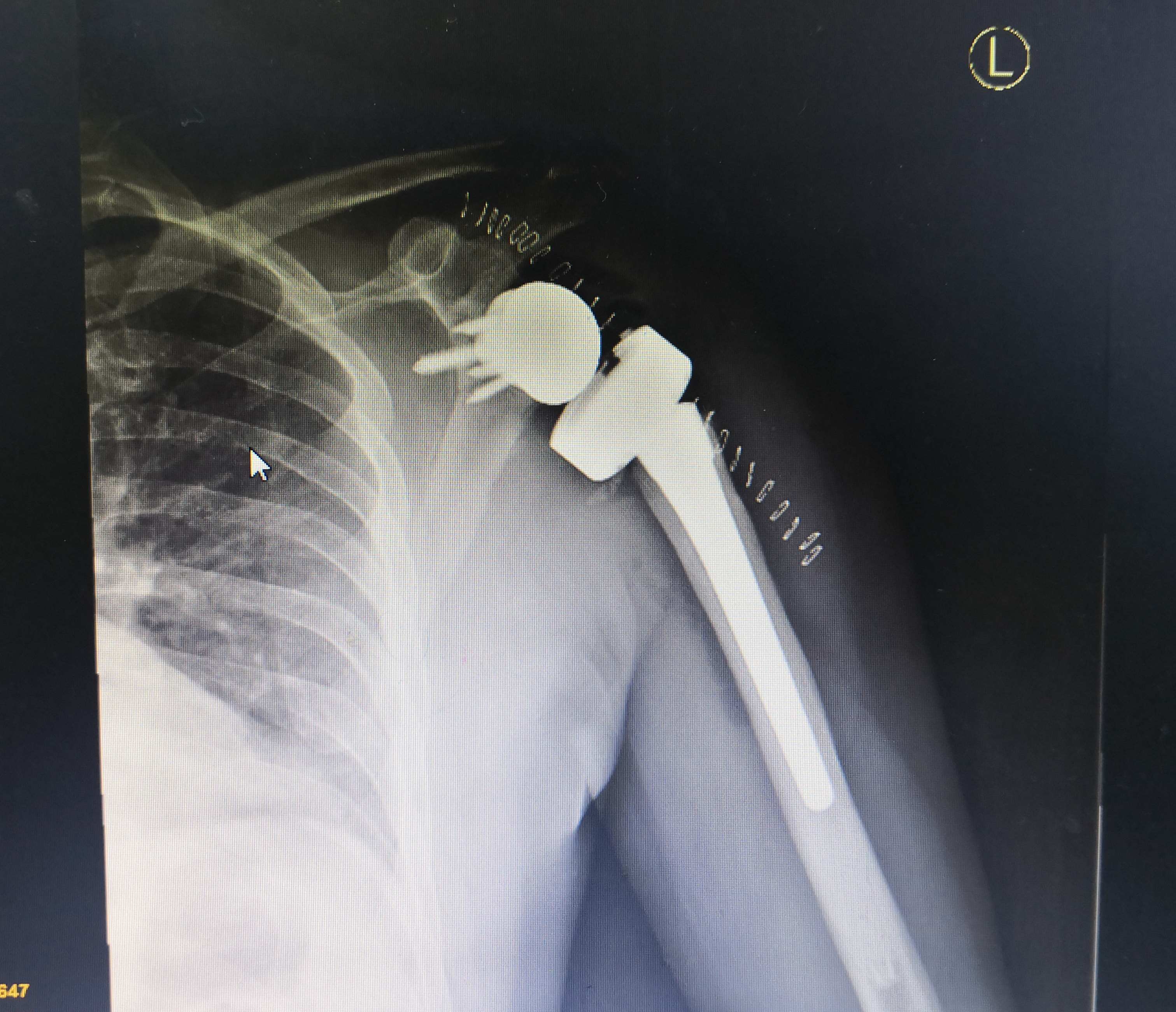 (术后影像)反置式人工全肩关节置换术(rtsa)是目前世界较高层次的医疗