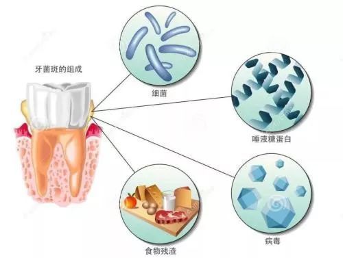 干扰细菌“交流”或能改善口腔健康，牙周病防治有了全新思路