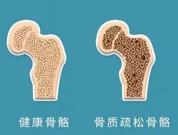 骨质疏松,即骨质疏松症,是一种让我们的骨骼变得脆弱的疾病,主要特征