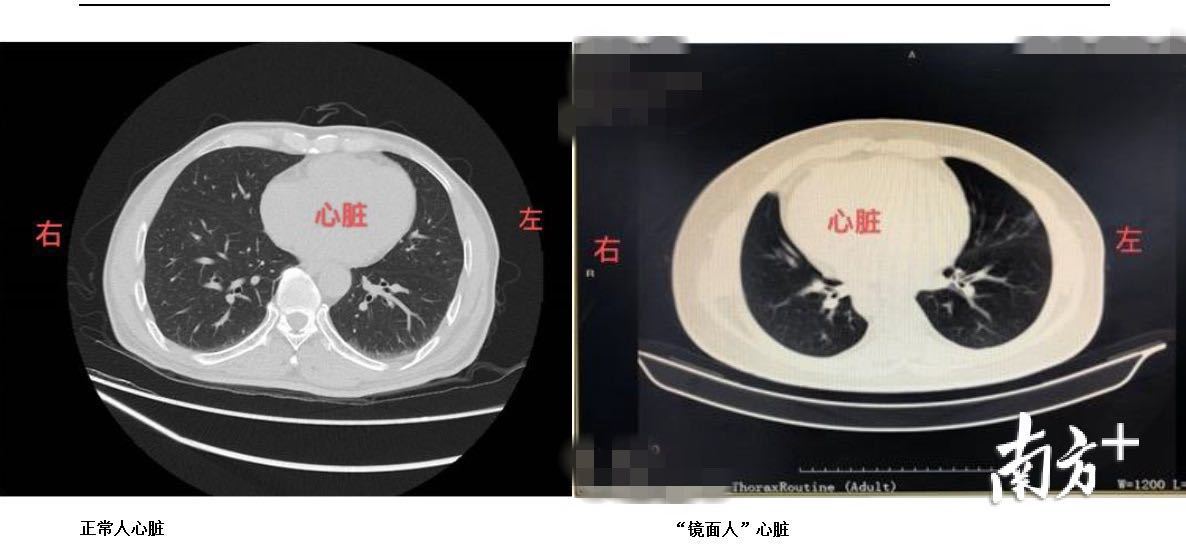 正常人心脏与“镜面人”心脏位置对比。受访者供图