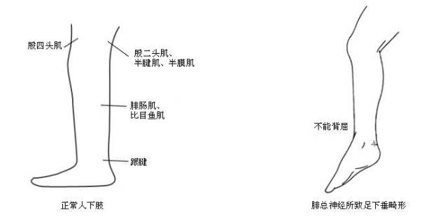 四旬妇足下垂不能行走胸椎管减压术后恢复正常 南方plus 南方