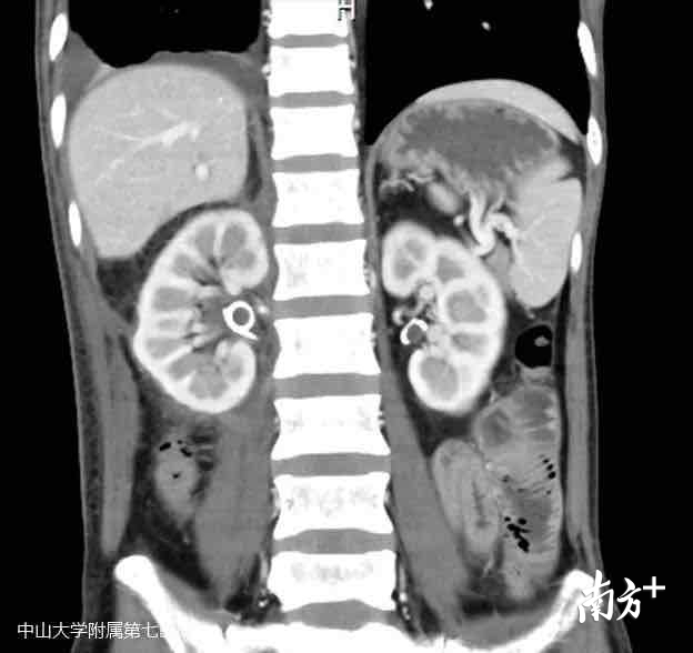 术后复查肿物切除干净,右肾回到生理位置 术后复查肿物切除干净,右肾回到生理位置