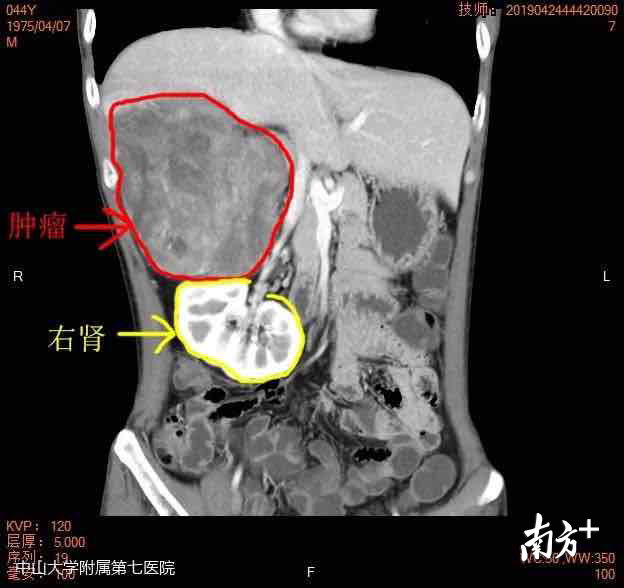 4月份CT检查发现巨大肿物,右肾受挤压 4月份CT检查发现巨大肿物,右肾受挤压