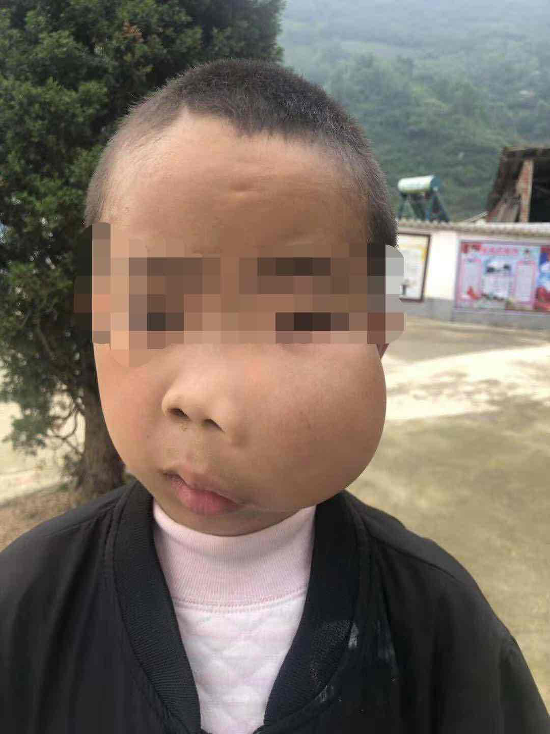 广州贵州两地千里爱心接力!"面目全非"患儿重拾笑容