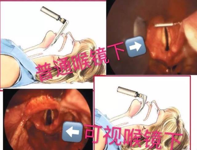 可视喉申请怎么可视喉镜，让气管内插管一目了然_https://www.jmylbn.com_新闻资讯_第1张