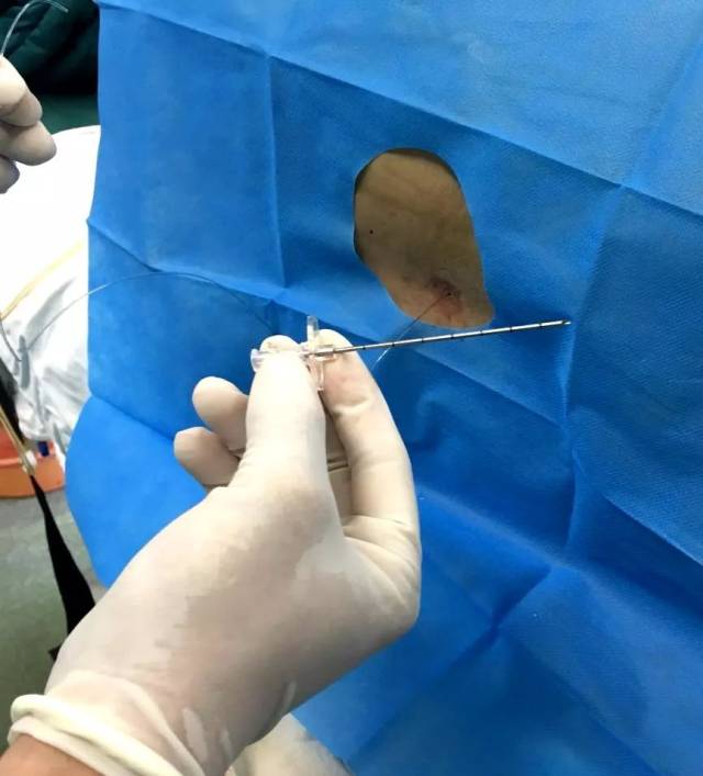 可视喉申请怎么可视喉镜，让气管内插管一目了然_https://www.jmylbn.com_新闻资讯_第3张