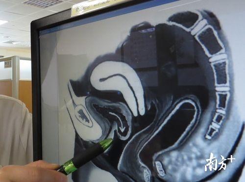 图为核磁共振下的膀胱脱垂表现