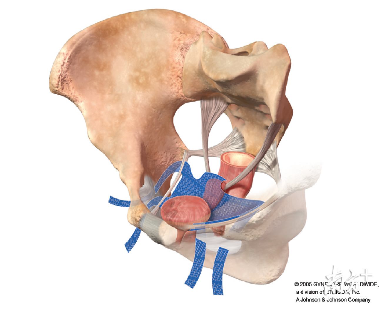 56岁女患者遭遇膀胱脱垂尴尬珠海医院首次引入新疗法