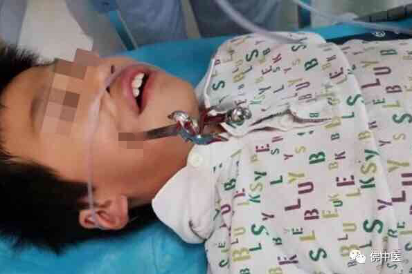 玩具剑斜刺入了小朋友的脸颊.