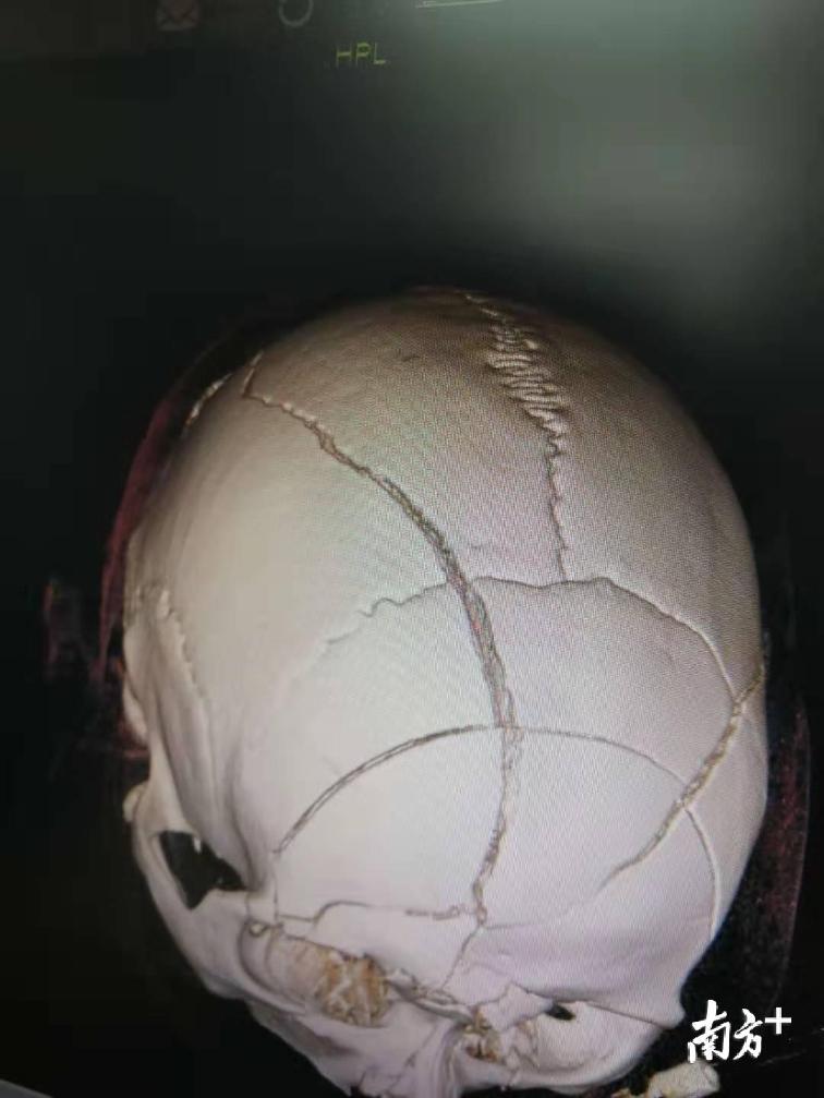 脑袋摔成烂西瓜医生这一招救了患者的命