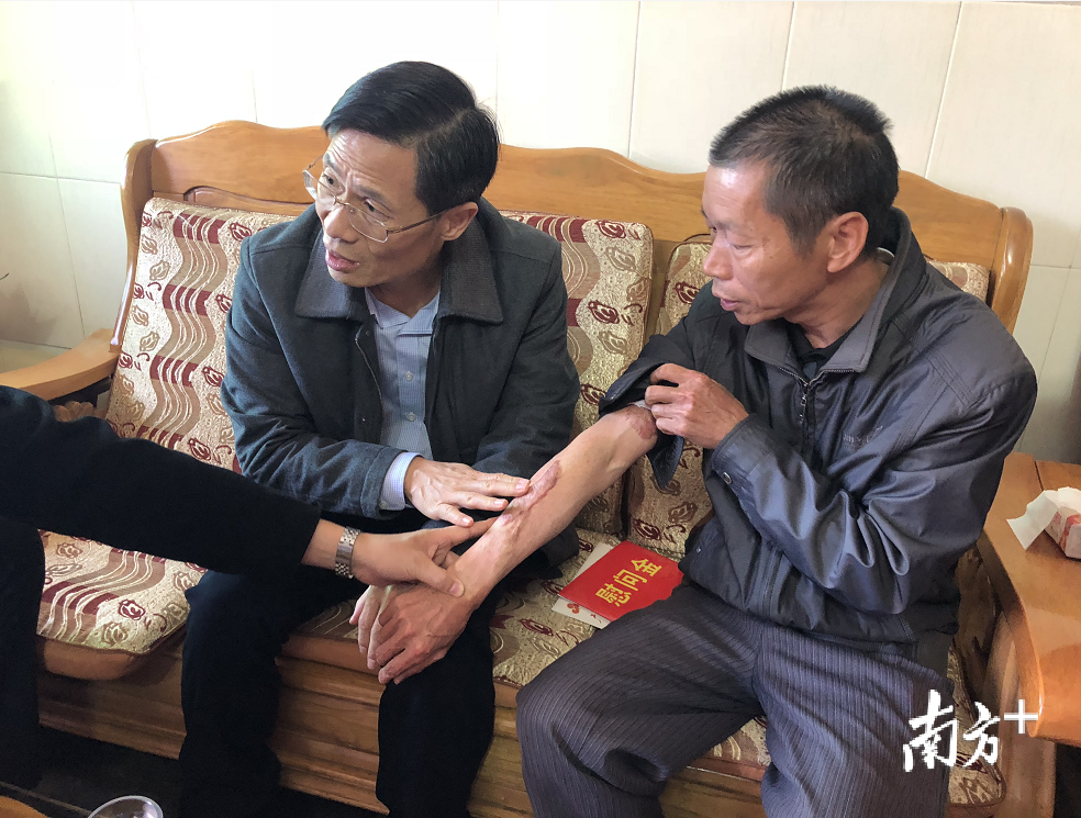 张金传身上仍有不少烧伤后的伤痕。