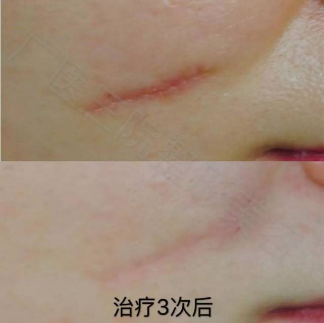 除疤技术不断进步 让伤痕不再困扰你