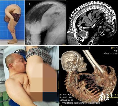 李华术前体态照片、术前CT及三维重建影像 李华术前体态照片、术前CT及三维重建影像