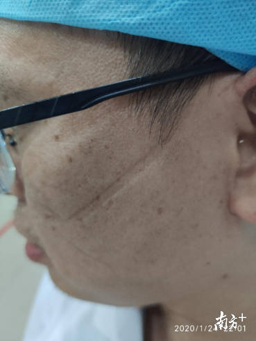 除夕夜,高明区人民医院急诊科内,因长时间佩戴防护口罩,一位医生的脸上出现了深深的口罩勒痕。 除夕夜,高明区人民医院急诊科内,因长时间佩戴防护口罩,一位医生的脸上出现了深深的口罩勒痕。