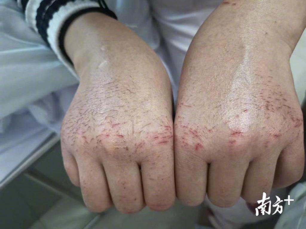 图集|致敬一线医护人员 勒出的血痕和泡肿的双手是你们的勋章