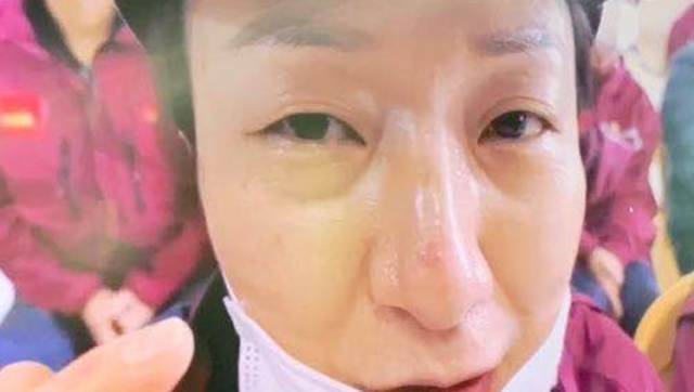 口罩在她们脸上留下“天使印记”，有了专用修复产品