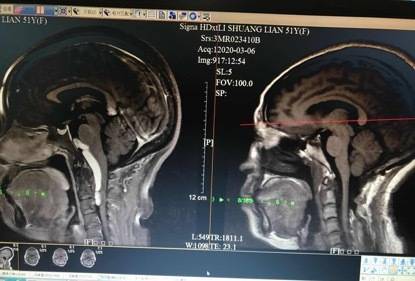 术前（左）术后（右）影像对比。