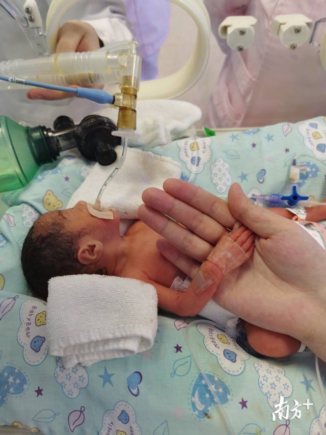 出生时不到2斤的小怡宝住过NICU、依赖呼吸机1个月。