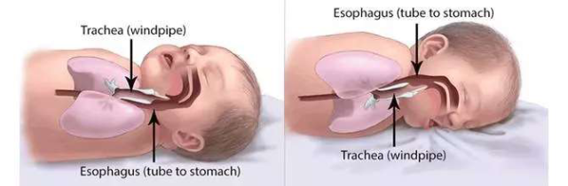 什么病忌用翻身床为什么【健康】痛心！宝宝趴睡训练身亡！什么才是正确睡姿？_https://www.jmylbn.com_新闻资讯_第3张