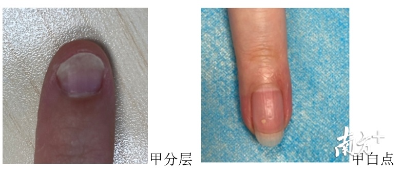 指甲分层,有白点