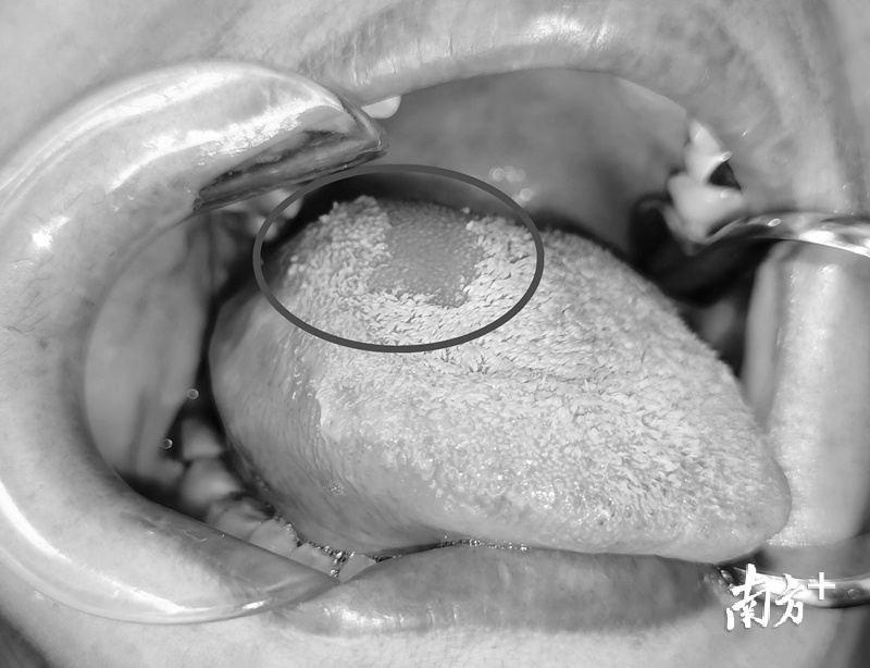 惊险！鱼刺扎进舌头半年，离舌癌仅一步之遥_南方plus_南方+