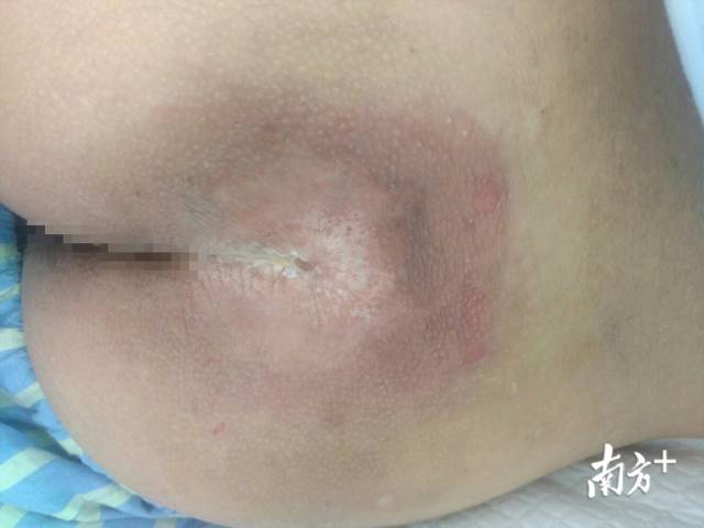 南方农村报 大压疮深可见骨中西医治疗一月愈合 南方医科大学中西医结合医院 南方农村报 大压疮深可见骨中西医治疗一月愈合 南方医科大学中西医结合医院