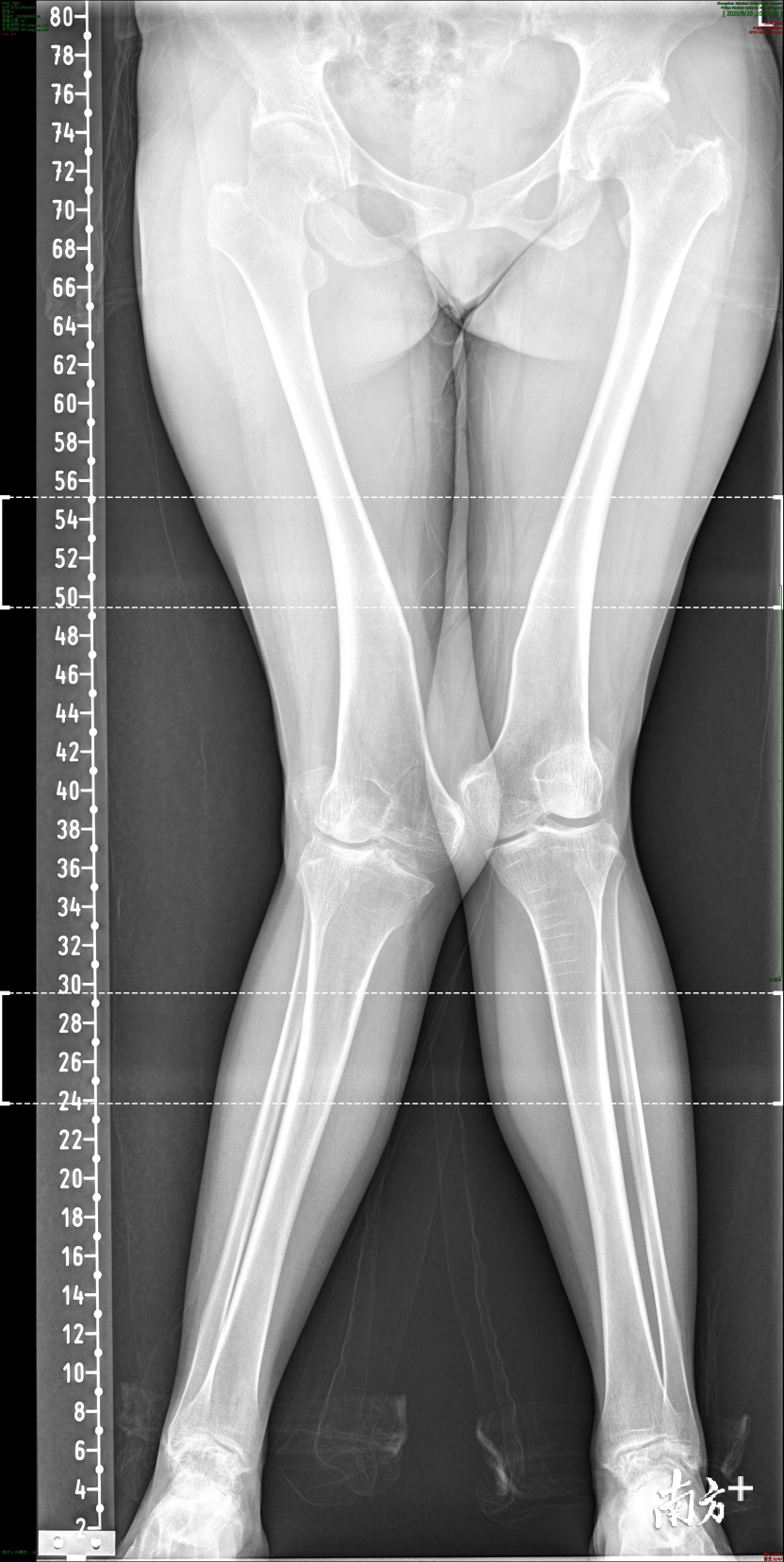 后天性膝外翻,就是我们通常所说的“X”形腿。 后天性膝外翻,就是我们通常所说的“X”形腿。