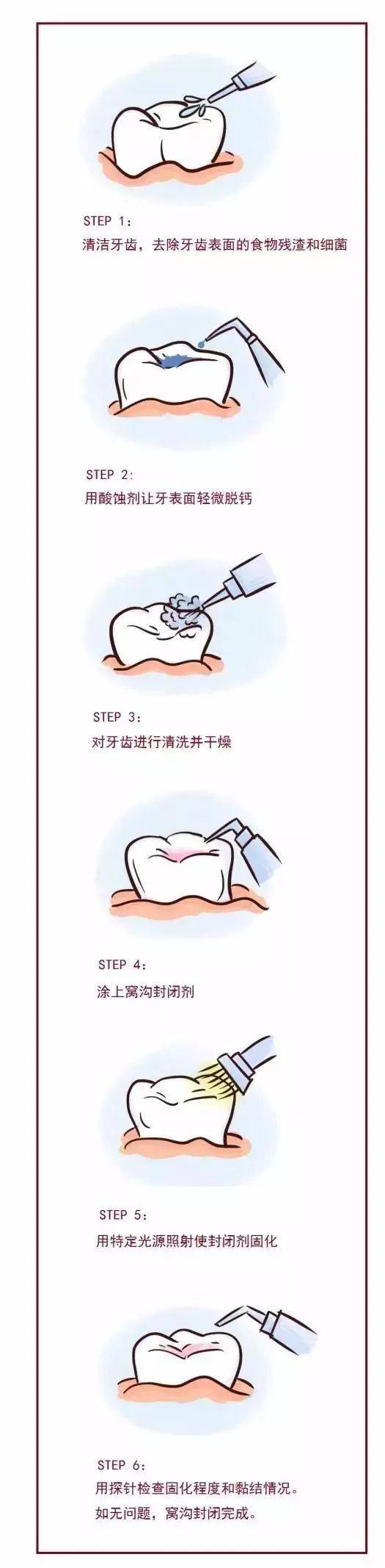 窝沟|【科普】小朋友必看！窝沟封闭是个啥？听完这首歌你就懂了