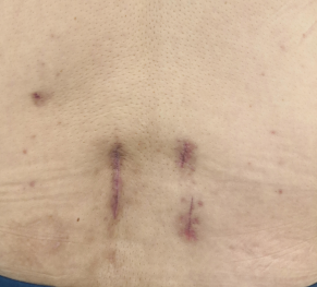 手术|腰突压迫左腿麻痛小便困难 三维导航下椎间孔腰椎减压固定融合术后缓解