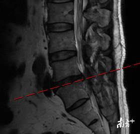 手术|腰突压迫左腿麻痛小便困难 三维导航下椎间孔腰椎减压固定融合术后缓解