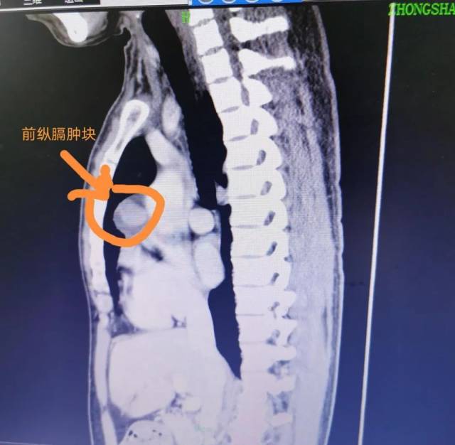胸腺|广东一男子突然睁不开眼，一查问题居然出在胸口！