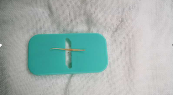 鱼刺|【外科苑】遗忘的鱼刺竟导致胃肠穿孔