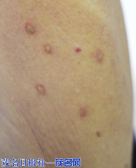 不要|信宜逾百人野外活动被蜂蜇伤 市民应注意防护