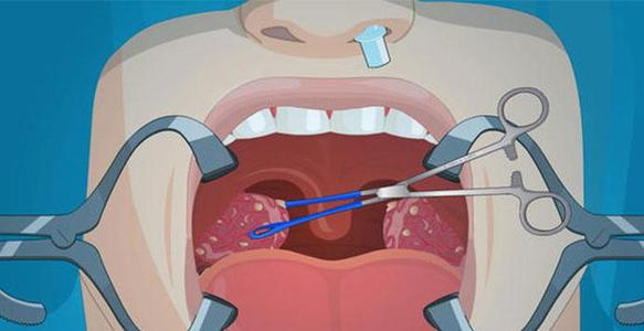 扁桃体|口臭、咽痛、异物感，竟然是结石搞的鬼！