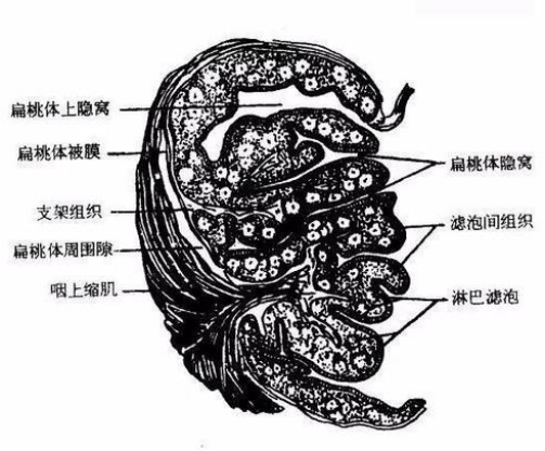 扁桃体|口臭、咽痛、异物感，竟然是结石搞的鬼！