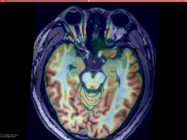 癫痫|常感莫名恐惧？肚子有股“仙气”？ 可能是颞叶癫痫哦！