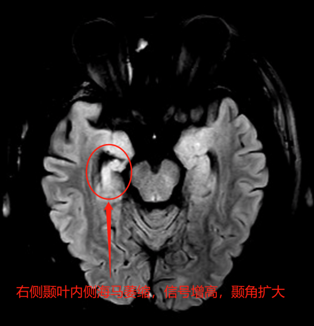 癫痫|常感莫名恐惧？肚子有股“仙气”？ 可能是颞叶癫痫哦！