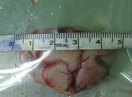 癫痫|常感莫名恐惧？肚子有股“仙气”？ 可能是颞叶癫痫哦！