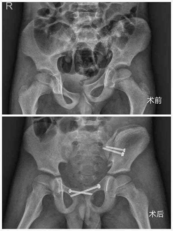 8岁男孩遇车祸骨盆骨折并神经损伤在南医三院手术获治 南方plus 南方