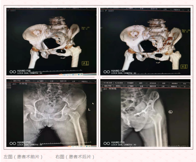 鹤山市中医院骨科二区成功开展一例高难度骨盆骨折手术 南方plus 南方